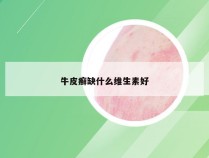 牛皮癣缺什么维生素好