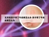 五岁的孩子得了牛皮癣怎么办 孩子得了牛皮皮癣怎么办