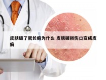 皮肤破了就长癣为什么 皮肤破损伤口变成皮癣