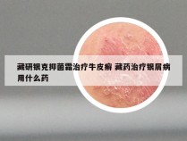 藏研银克抑菌霜治疗牛皮癣 藏药治疗银屑病用什么药