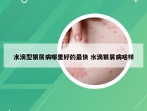 水滴型银屑病哪里好的最快 水滴银屑病啥样