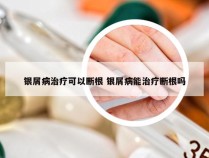 银屑病治疗可以断根 银屑病能治疗断根吗