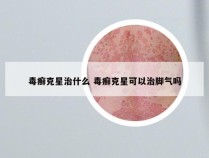 毒癣克星治什么 毒癣克星可以治脚气吗