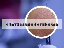 小孩的下体的皮肤长癣 宝宝下面长癣怎么办