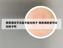 银屑病关节炎能不能吃桃子 银屑病患者可以吃桃子吗