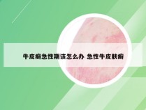 牛皮癣急性期该怎么办 急性牛皮肤癣