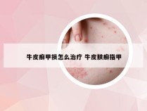 牛皮癣甲损怎么治疗 牛皮肤癣指甲