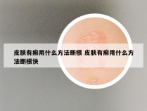 皮肤有癣用什么方法断根 皮肤有癣用什么方法断根快