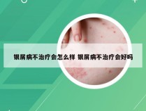 银屑病不治疗会怎么样 银屑病不治疗会好吗