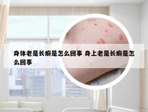 身体老是长癣是怎么回事 身上老是长癣是怎么回事