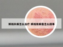 裤裆长癣怎么治疗 裤裆有癣是怎么回事