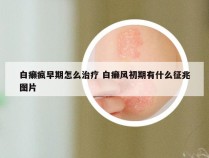 白癞疯早期怎么治疗 白癞风初期有什么征兆图片