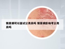 银屑病可以面试公务员吗 银屑病影响考公务员吗