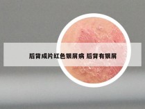 后背成片红色银屑病 后背有银屑