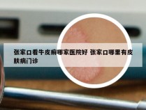 张家口看牛皮癣哪家医院好 张家口哪里有皮肤病门诊