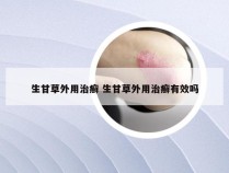 生甘草外用治癣 生甘草外用治癣有效吗