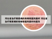 河北省治疗银屑病的有哪些医院最好 河北省治疗银屑病的有哪些医院最好的医生