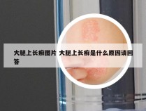 大腿上长癣图片 大腿上长癣是什么原因请回答