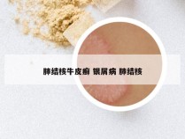 肺结核牛皮癣 银屑病 肺结核