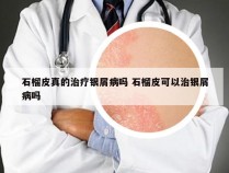 石榴皮真的治疗银屑病吗 石榴皮可以治银屑病吗