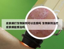 皮肤病打生物制剂可以出根吗 生物制剂治疗皮肤病能根治吗