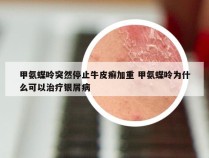 甲氨蝶呤突然停止牛皮癣加重 甲氨蝶呤为什么可以治疗银屑病