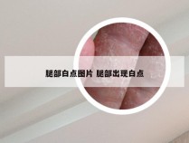 腿部白点图片 腿部出现白点