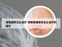 掌脓疱疹怎么治疗 掌脓疱病症状怎么治疗的秘方