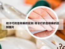 蚊子叮的包和癣的区别 蚊子叮的包和癣的区别图片