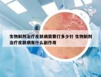 生物制剂治疗皮肤病需要打多少针 生物制剂治疗皮肤病有什么副作用