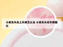 小朋友头皮上长癣怎么治 小朋友头皮长癣图片