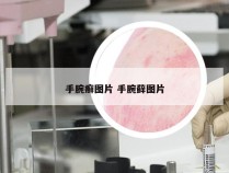 手腕癣图片 手腕藓图片