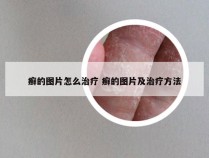 癣的图片怎么治疗 癣的图片及治疗方法