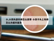 小,小孩头部长癣怎么回事 小孩子头上有癣怎么办越长越多