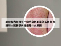 屁股和大腿根有一块块白色的是怎么回事 屁股和大腿根部长痘痘是什么原因