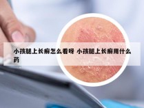 小孩腿上长癣怎么看呀 小孩腿上长癣用什么药