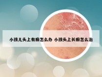 小孩儿头上有癣怎么办 小孩头上长癣怎么治