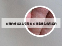 白斑的症状怎么引起的 白斑是什么病引起的