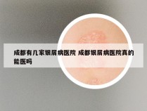 成都有几家银屑病医院 成都银屑病医院真的能医吗