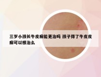 三岁小孩长牛皮癣能更治吗 孩子得了牛皮皮癣可以根治么