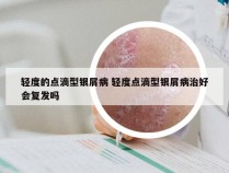 轻度的点滴型银屑病 轻度点滴型银屑病治好会复发吗