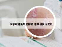 本草纲目治牛皮癣的 本草纲目治皮炎