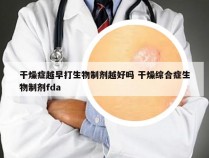 干燥症越早打生物制剂越好吗 干燥综合症生物制剂fda