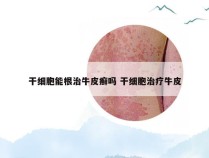 干细胞能根治牛皮癣吗 干细胞治疗牛皮