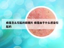 癣是怎么引起的藓图片 癣是由于什么感染引起的