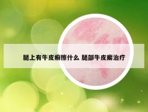 腿上有牛皮癣擦什么 腿部牛皮廨治疗