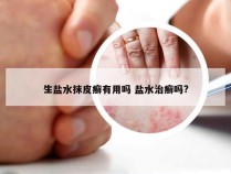 生盐水抹皮癣有用吗 盐水治癣吗?