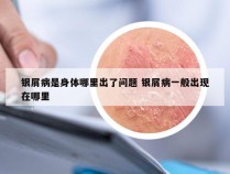 银屑病是身体哪里出了问题 银屑病一般出现在哪里