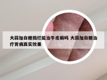 大蒜加白糖捣烂能治牛皮癣吗 大蒜加白糖治疗胃病真实效果