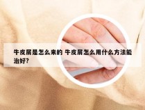 牛皮屑是怎么来的 牛皮屑怎么用什么方法能治好?